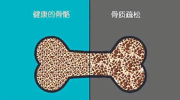 心理健康也會影響骨骼健康導(dǎo)致骨質(zhì)流失？.jpg