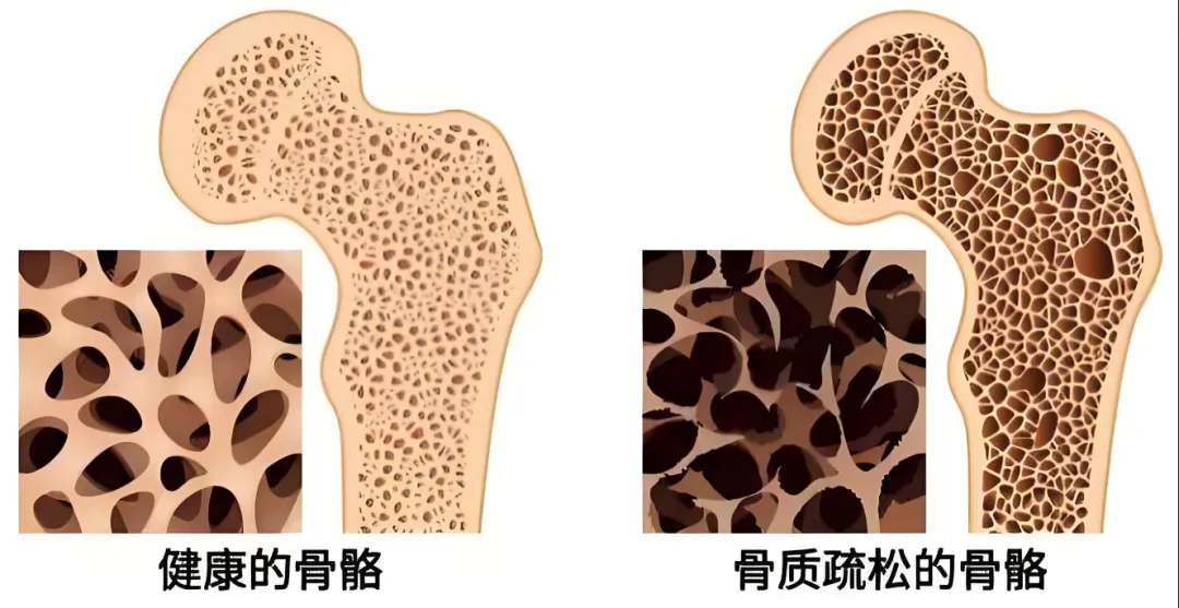 骨質疏松骨骼.png